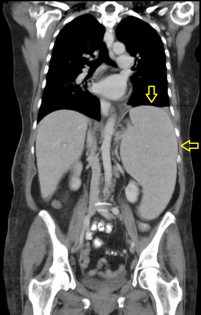 Splenomegalie eine vergrößerte Milz Ursachen Symptome Behandlung